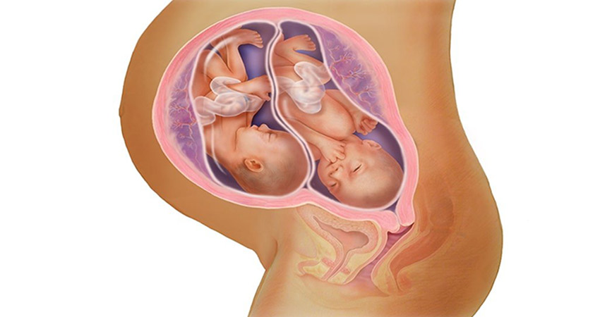 ikiz gebelikte normal doğum, ikiz hamilelikte normal doğum